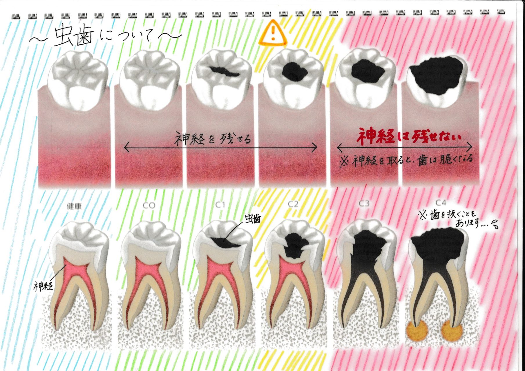 神経 抜い た 歯 抜歯